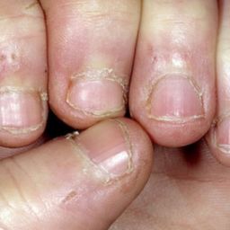 Por qué morderse las uñas y qué puede hacer para evitarlo